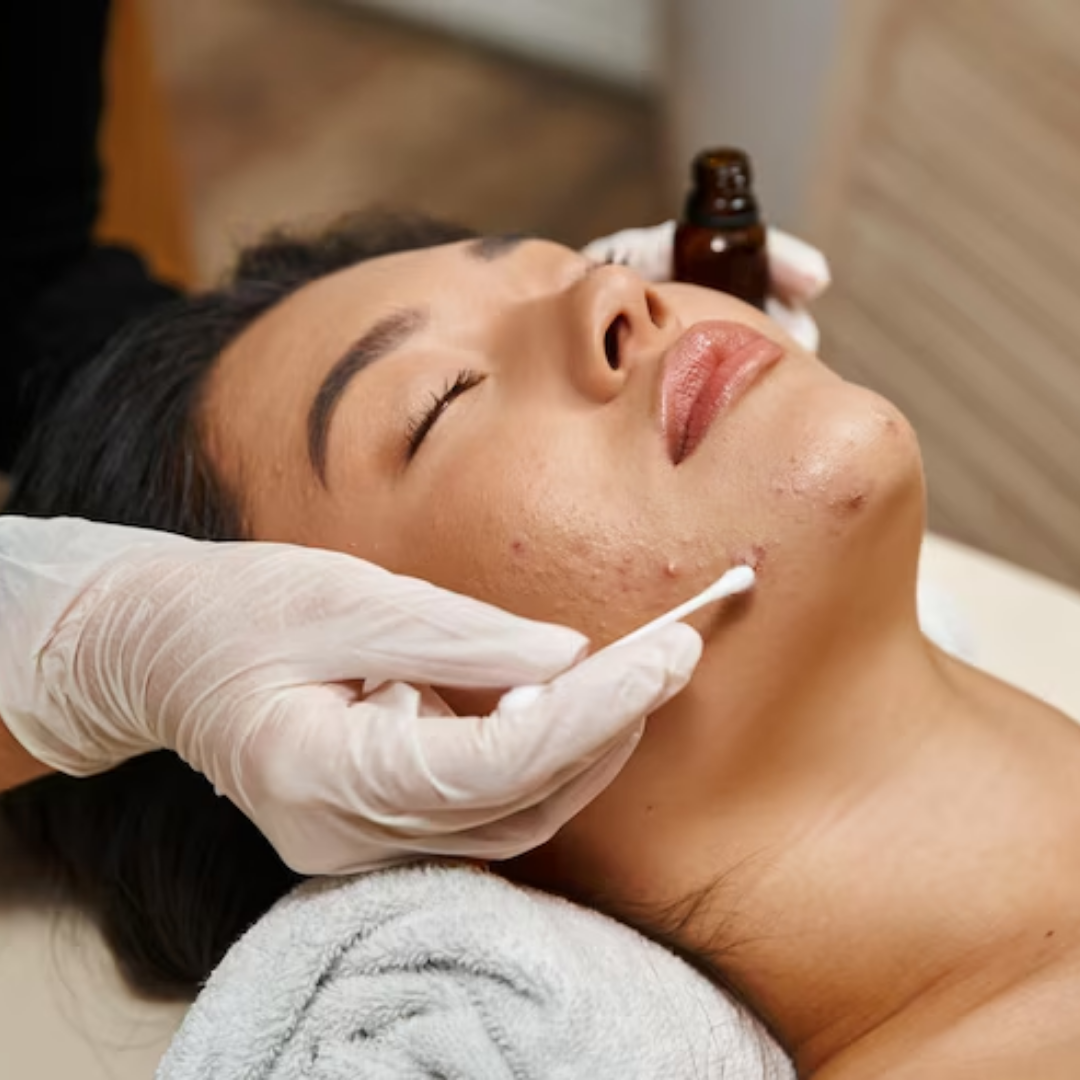 Anti-Acne Facial